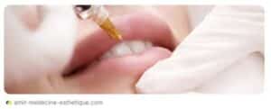 Injection d'acide hyaluronique